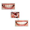 Dentier Amovible - Pour Un Sourire Plus Confiant